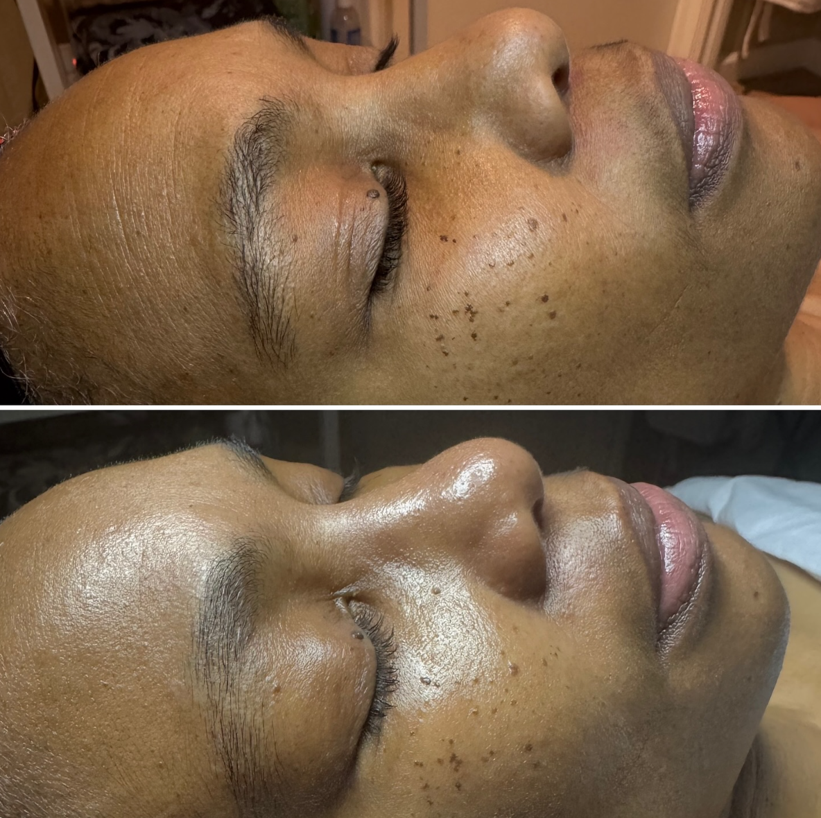 Close-up of a woman’s face before and after skincare treatment, showing improvements in skin texture, pore size, and complexion.