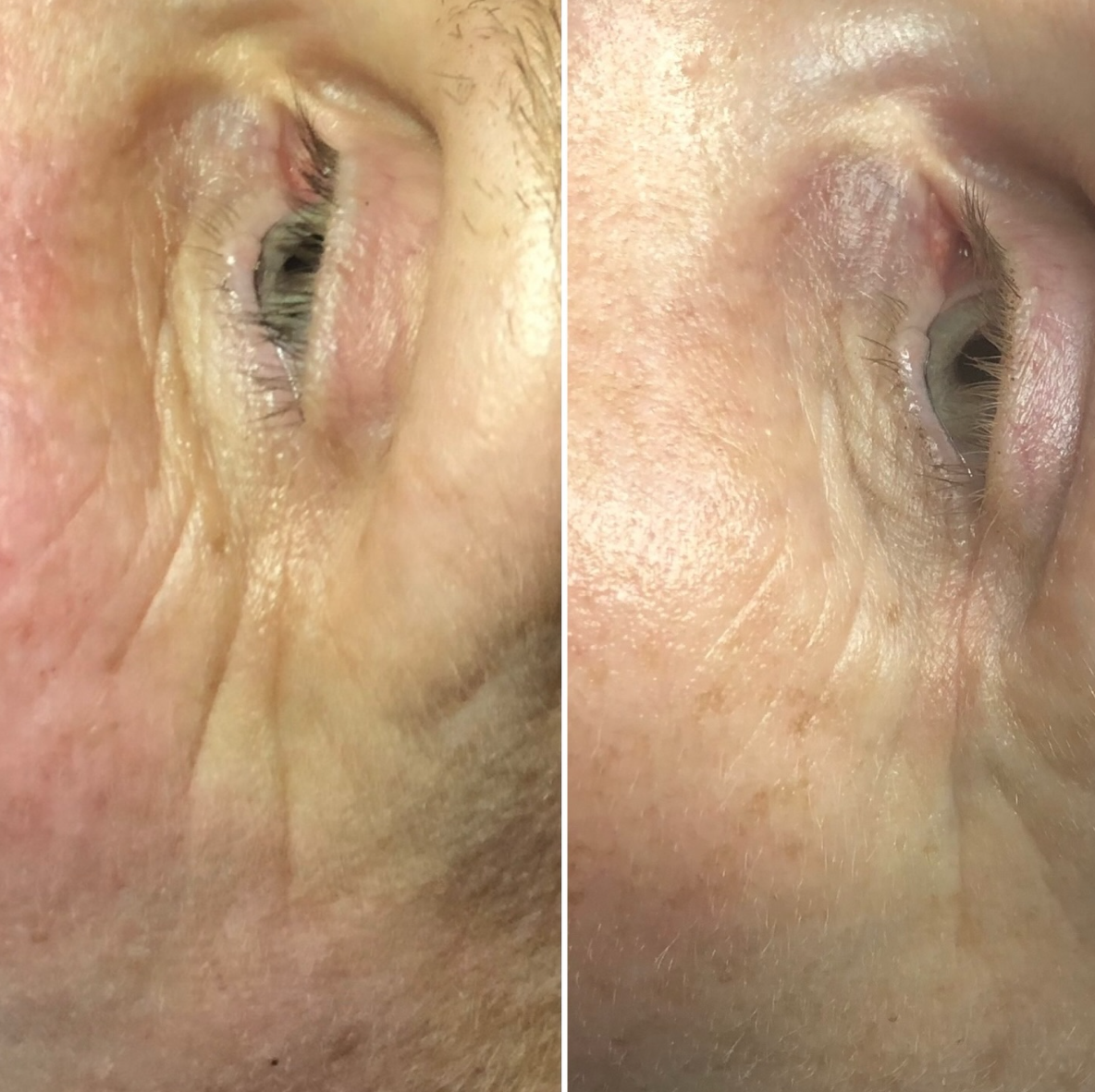 Close-up comparison of an eye area showing skin texture and condition before and after treatment or skincare.