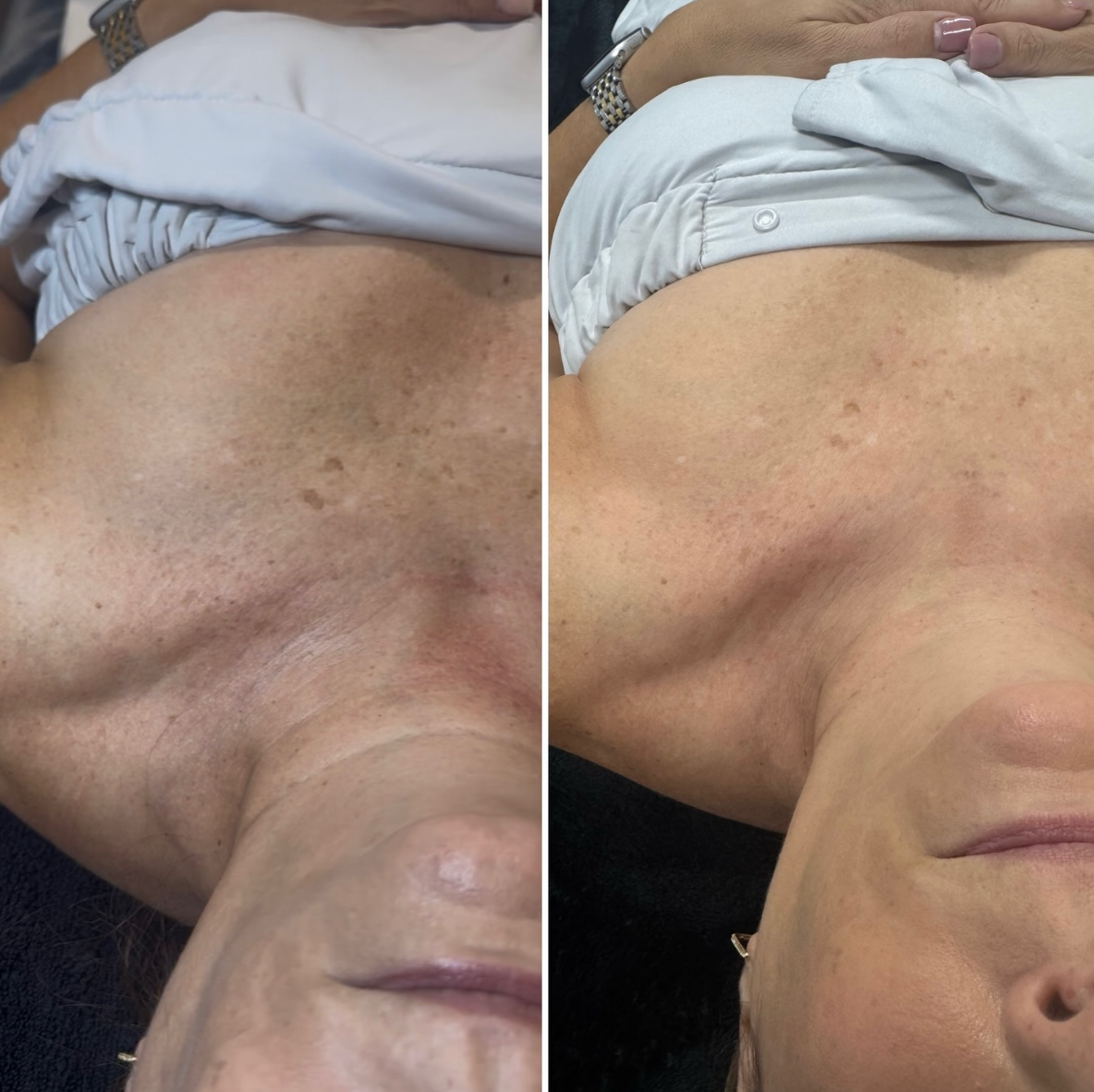 Comparison of skin condition before and after treatment, showing improved skin clarity and reduced pigmentation on a person's upper chest.