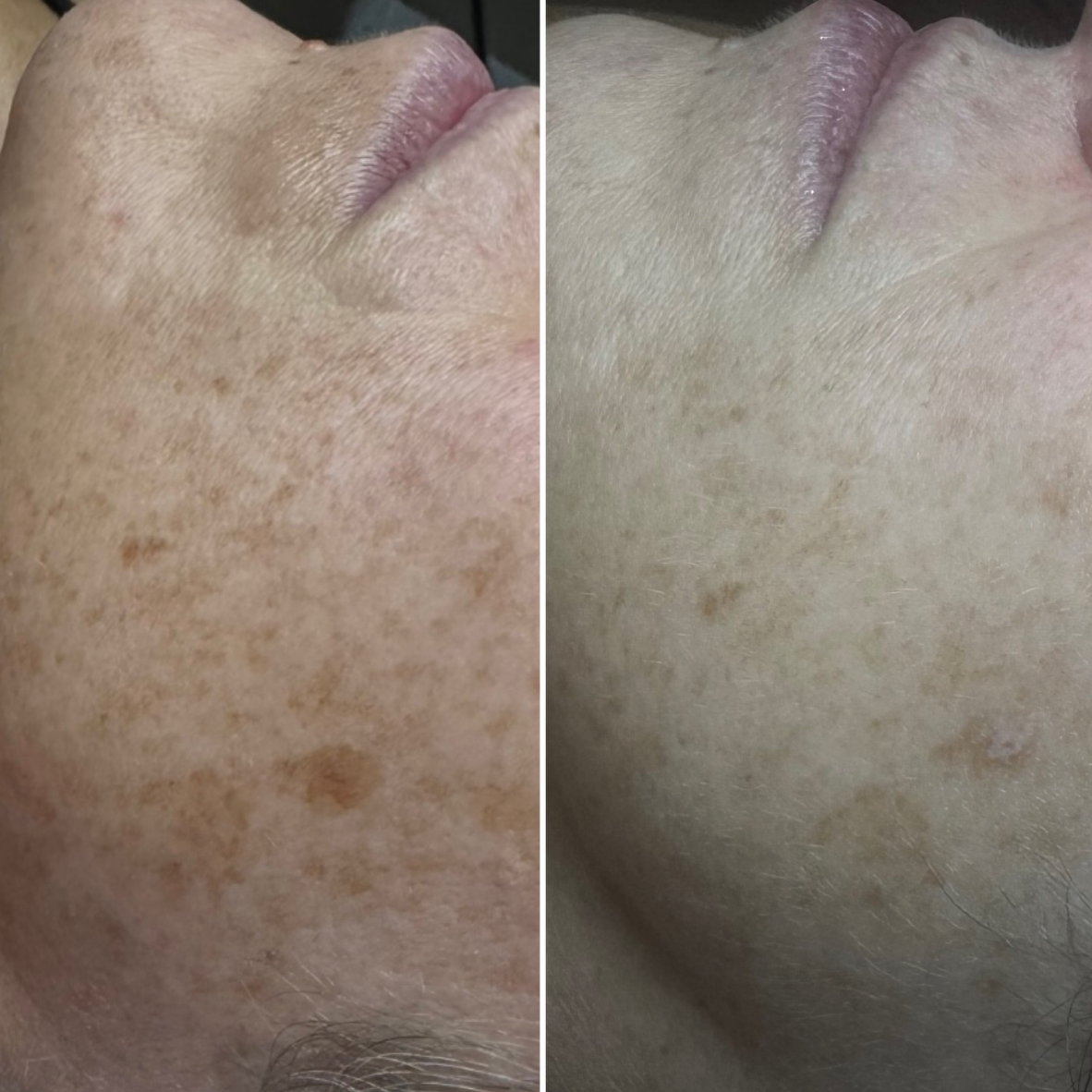 Close-up side-by-side comparison of a person's face showing skin with age spots or hyperpigmentation on the left and clearer skin on the right.