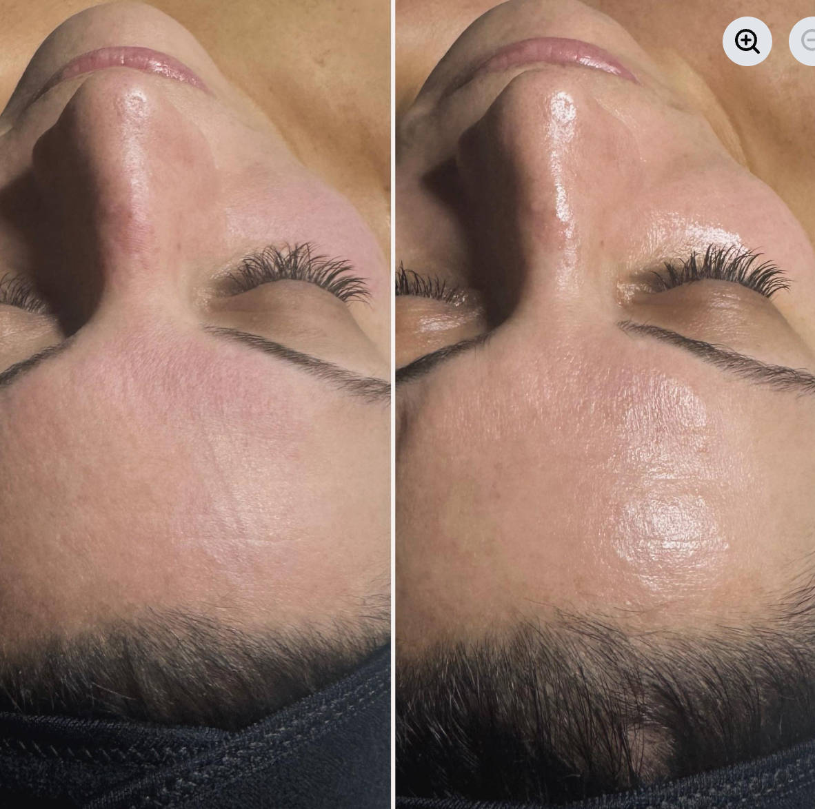 Close-up of a person's face showing a before-and-after comparison, focusing on the forehead and nose, highlighting skin smoothing or treatment results.