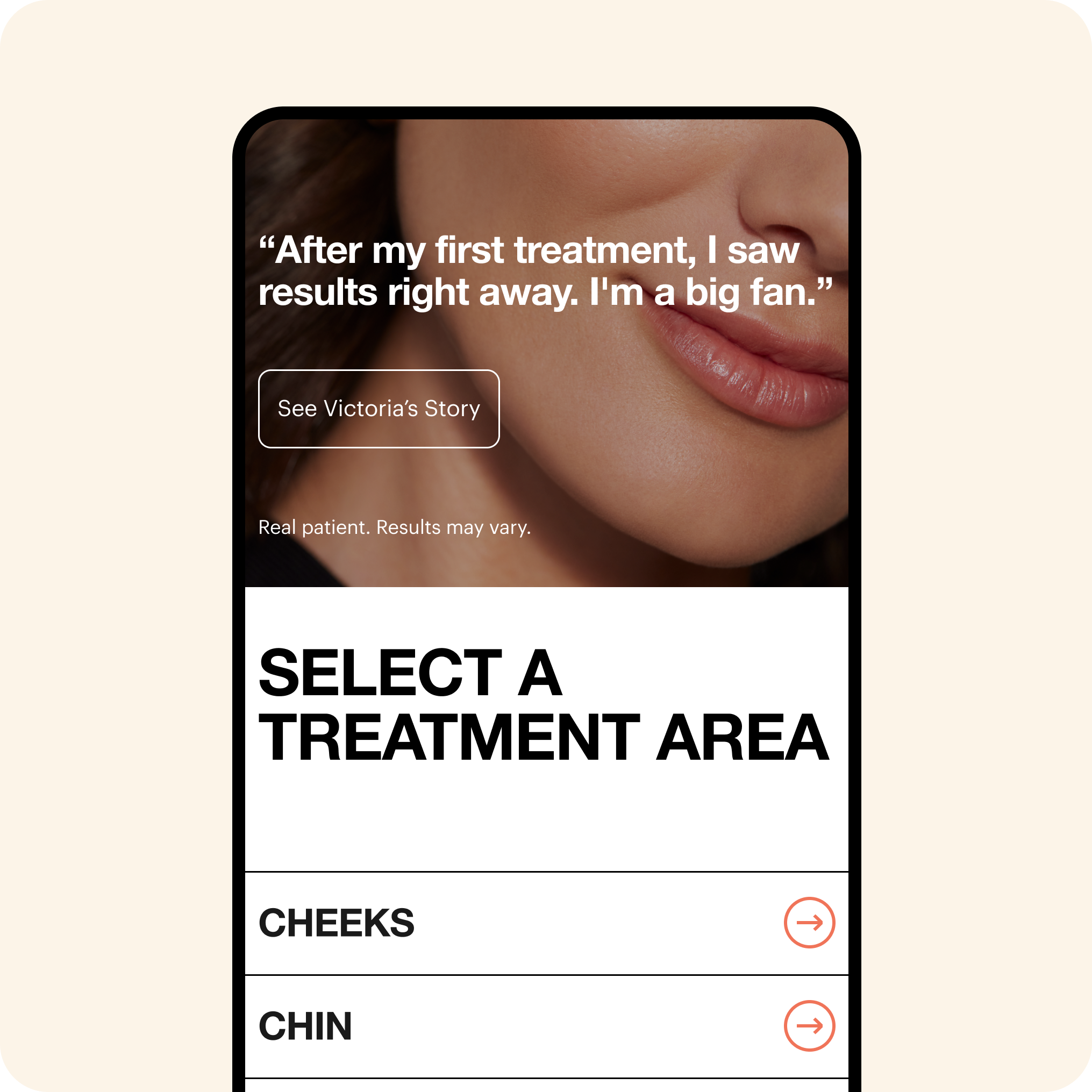 Juvederm - Mobile - Treatment Area Example.png