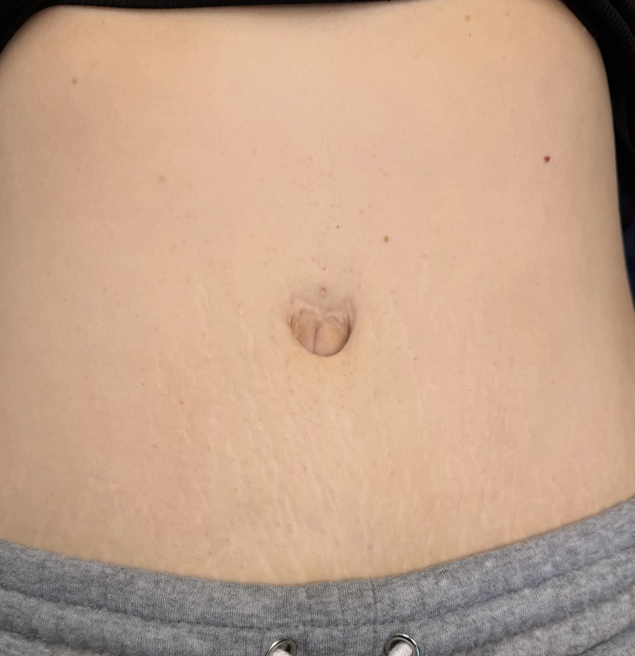At 6 weeks. The stretch marks have now come to surface and also shrinking in width. Amazing first 6 week check-in. 