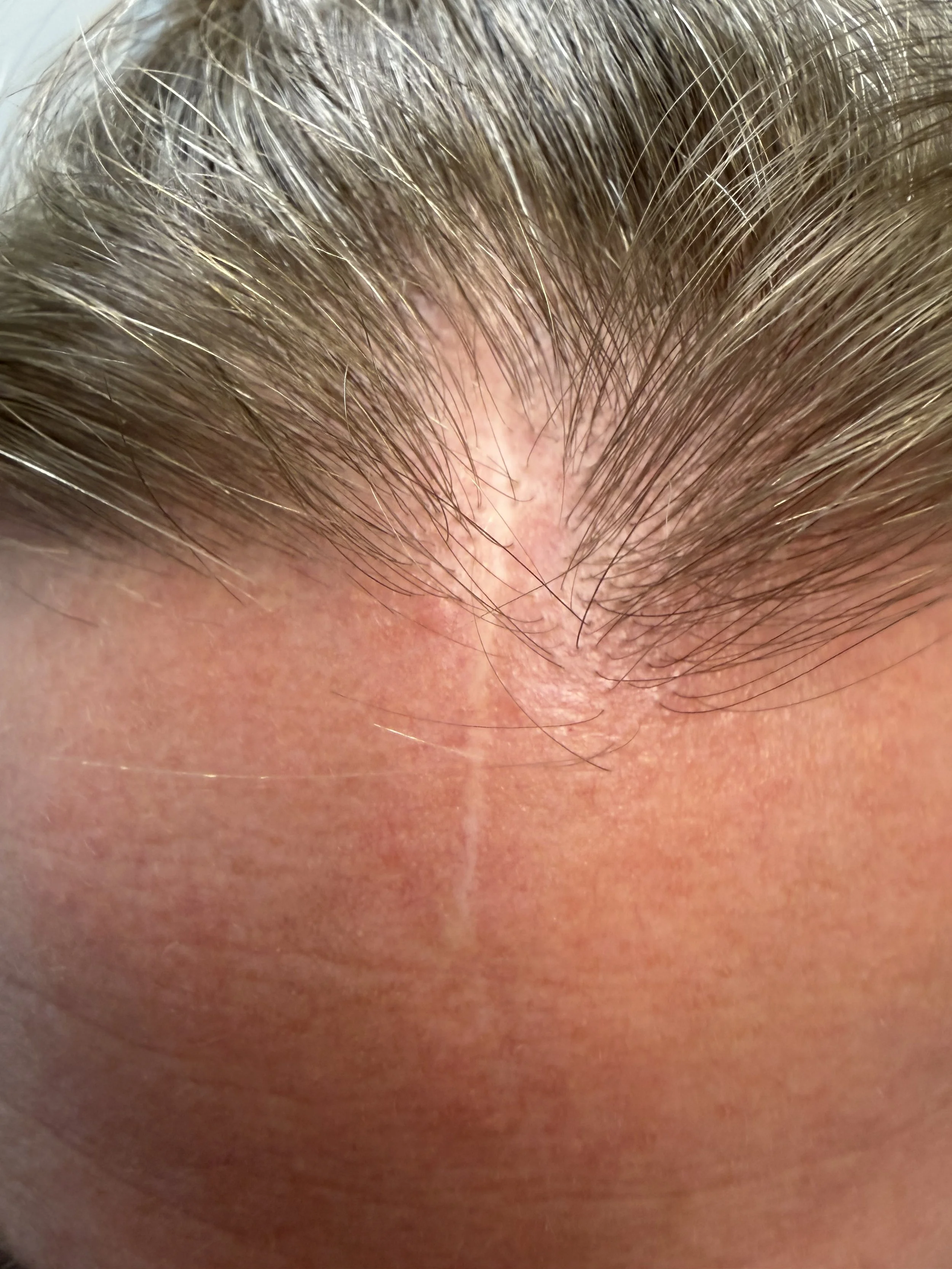 Close-up of a person's scalp with light brown hair, showing some hair strands and skin.