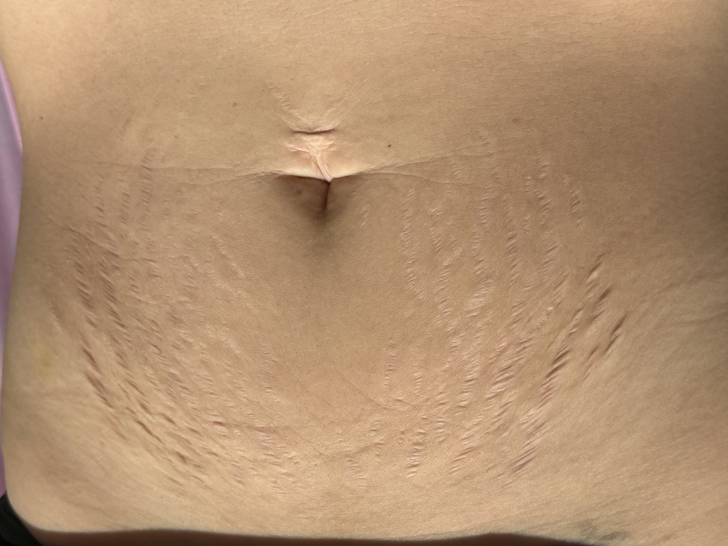Close-up of human skin with some stretch marks and a belly button.