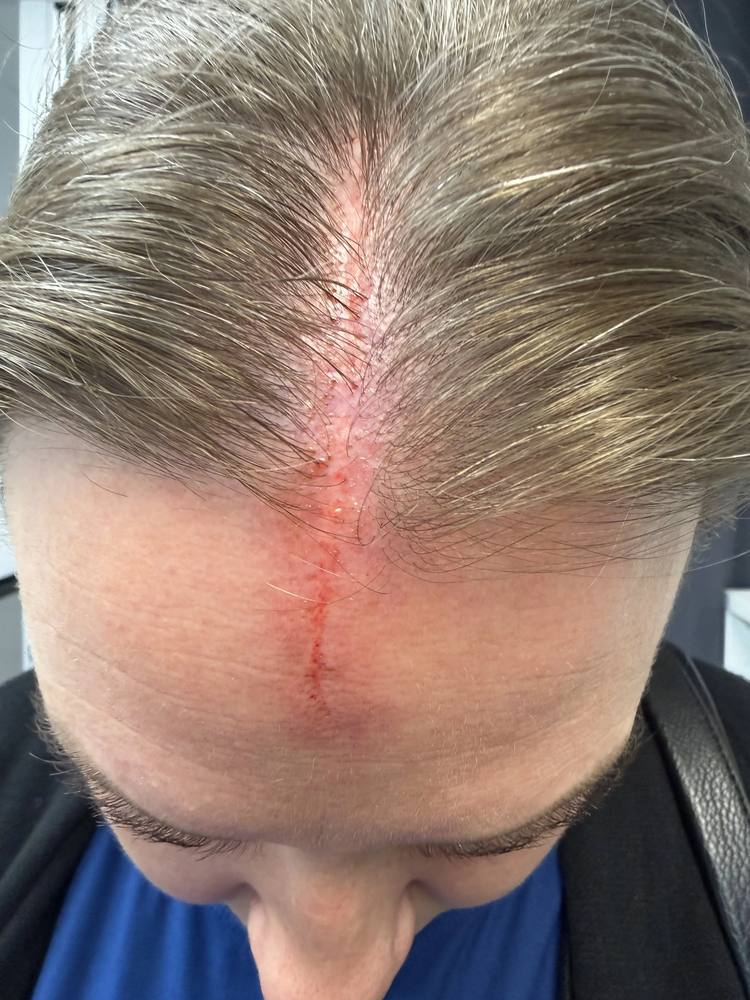 Top of a person's head showing a shaved scalp with a vertical surgical scar and some redness.