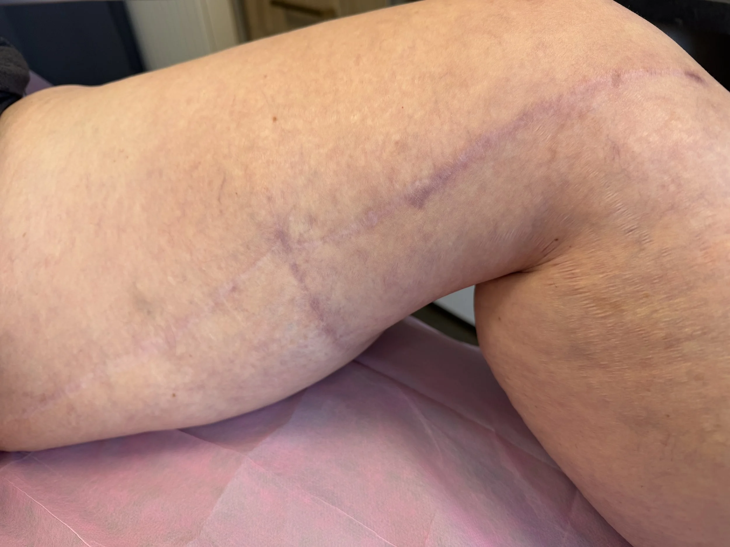 Close-up of a person's skin with visible veins, a scar, and some small moles or blemishes.