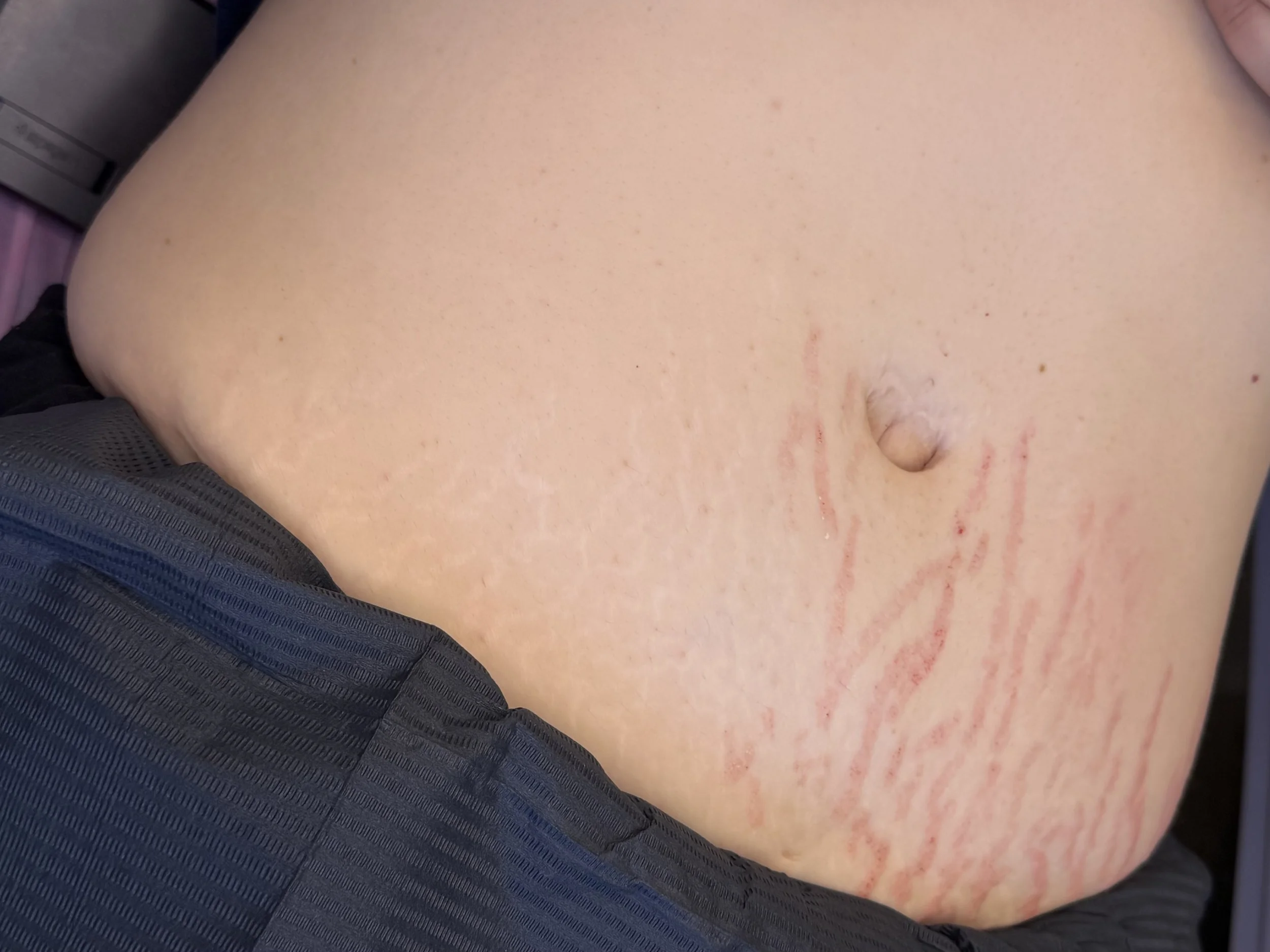 Close-up of a person's lower back and upper buttocks with visible stretch marks and skin imperfections, wearing dark gray pants.