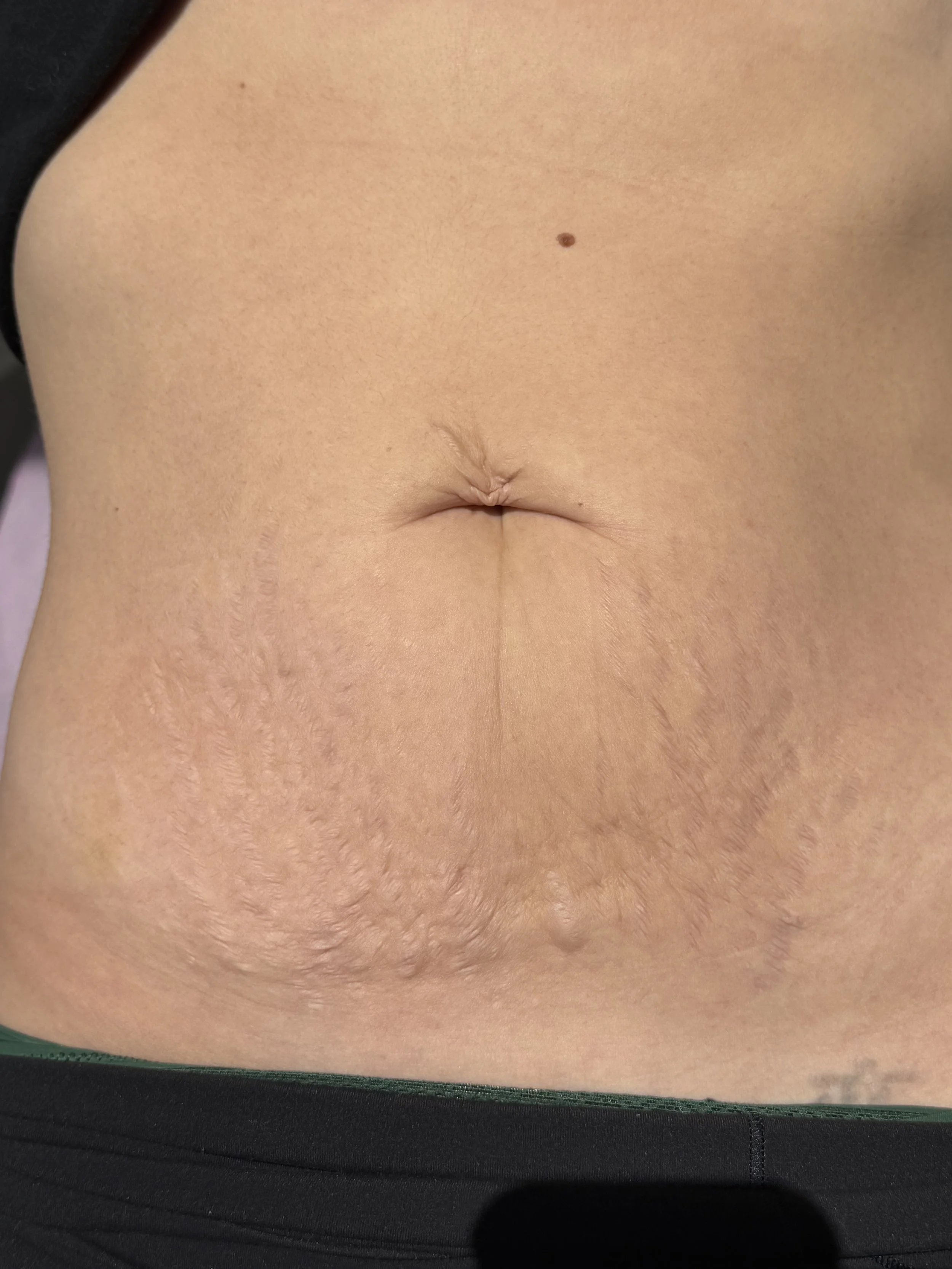 Close-up of a person's lower abdomen and part of their pelvis, showing skin with natural texture and some body hair, and the waistband of black clothing.