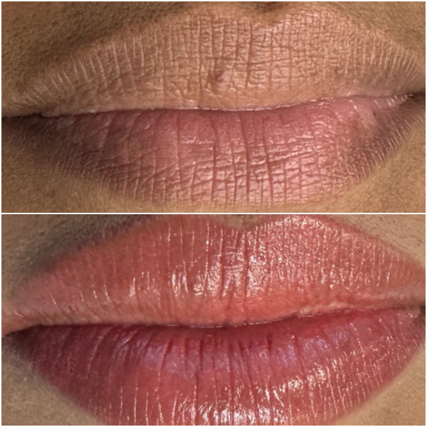 Lip Neutralization by Lina