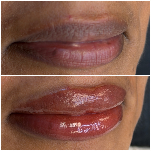 Dark Lip Neutralization by Lina
