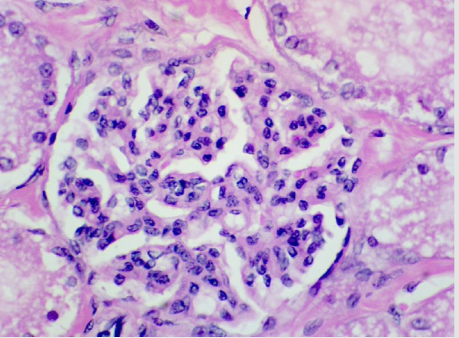 Microscopic view of tissue showing numerous cell nuclei, stained purple, with some white spaces indicating extracellular matrix or spaces between cells.
