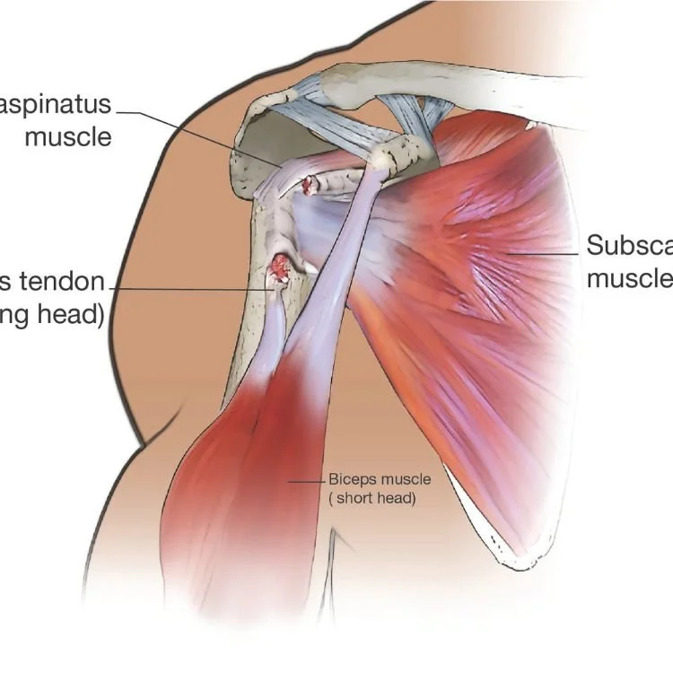 An anatomical illustration of the shoulder muscles, showing the supraspinatus, subscapularis, and biceps muscles, along with tendons and surrounding tissues.