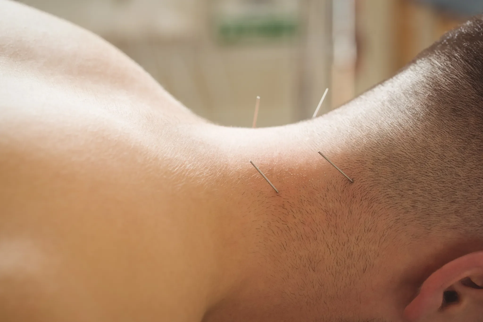 A person lying face down with acupuncture needles inserted into their back.