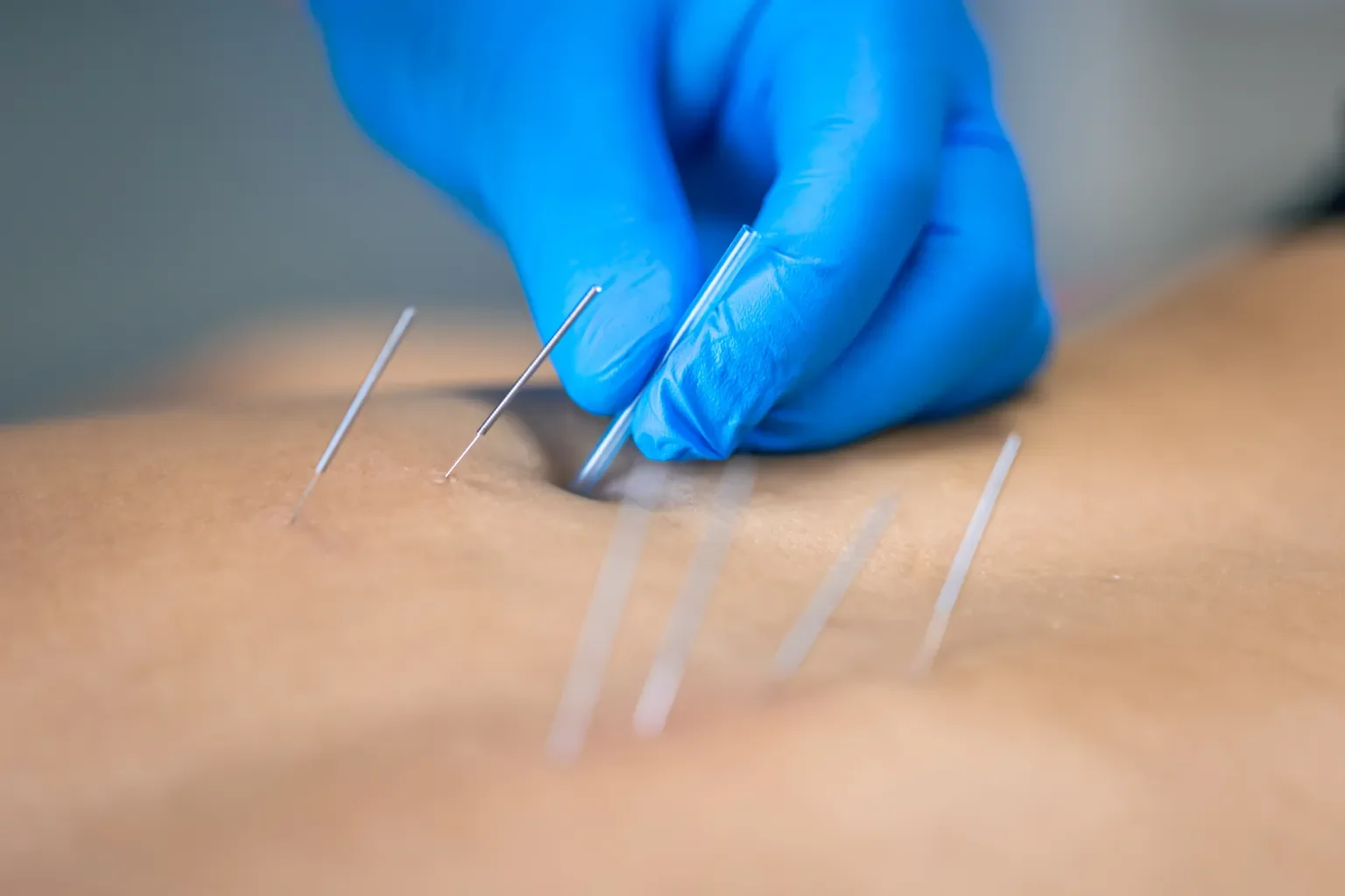 Close-up of a person wearing blue gloves inserting acupuncture needles into skin.