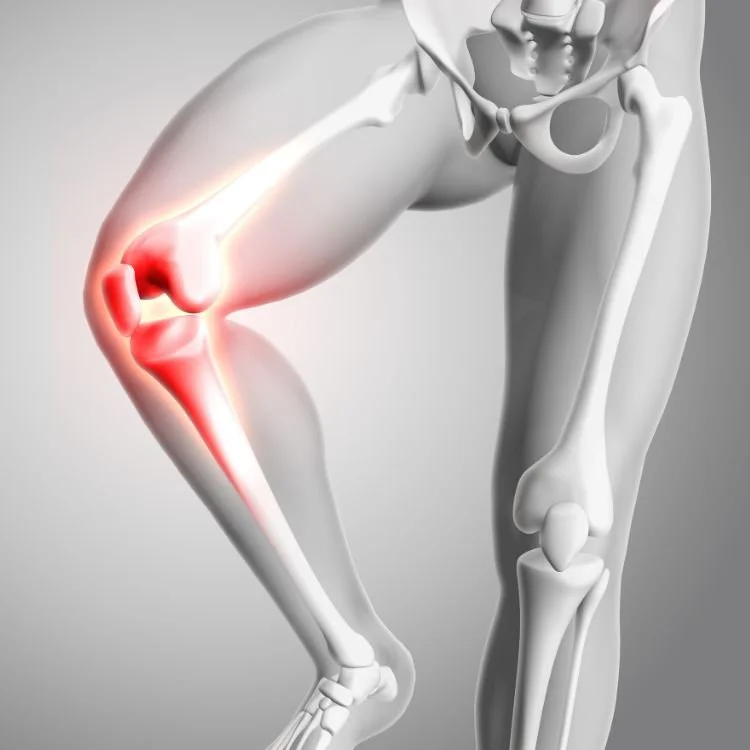 3D illustration of a human pelvis and leg bones highlighting the knee joint with inflamed and red areas indicating pain or injury.