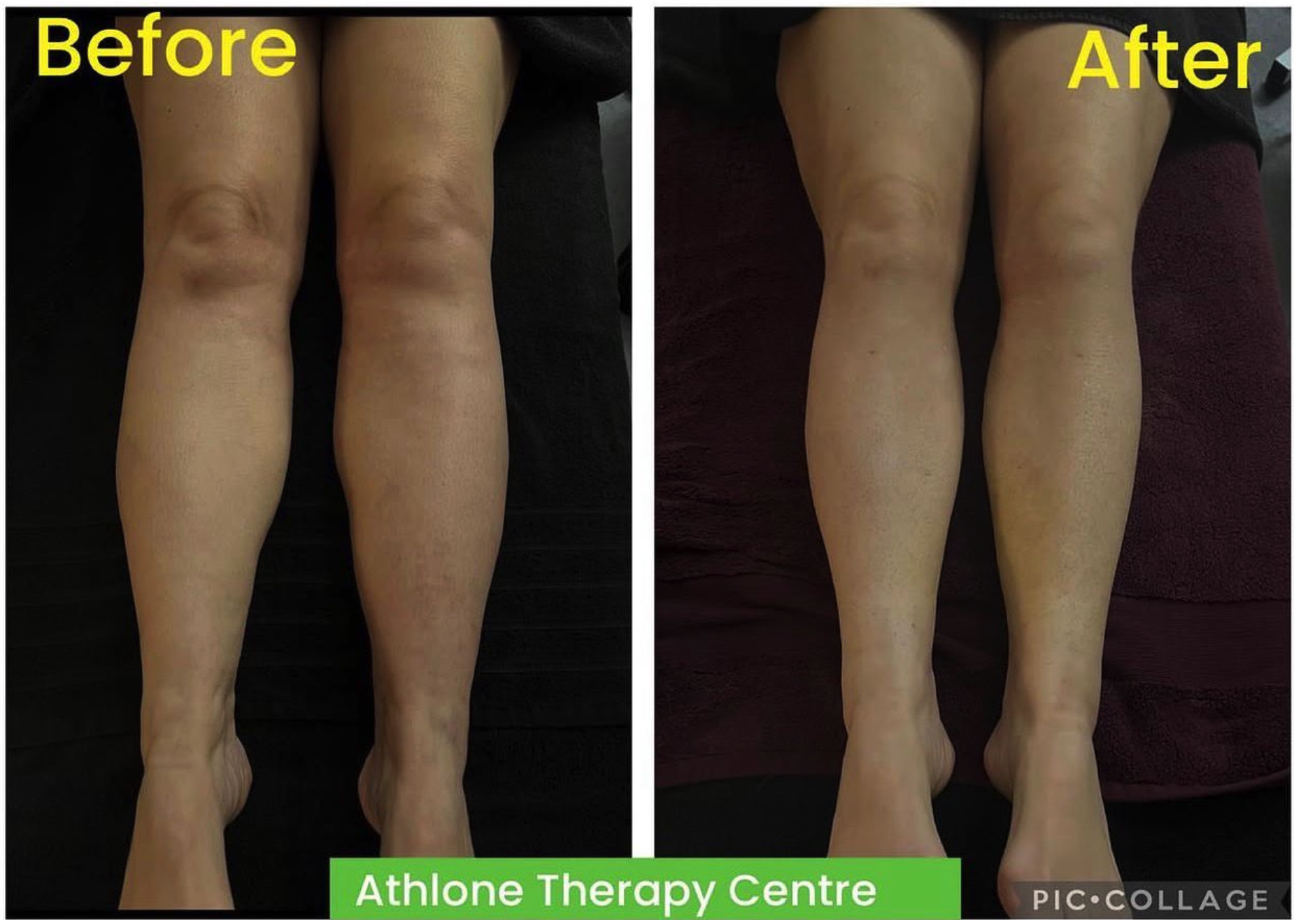 Side-by-side comparison of legs before and after treatment at Athlone Therapy Centre, showing reduced swelling and improved skin appearance in the after image.