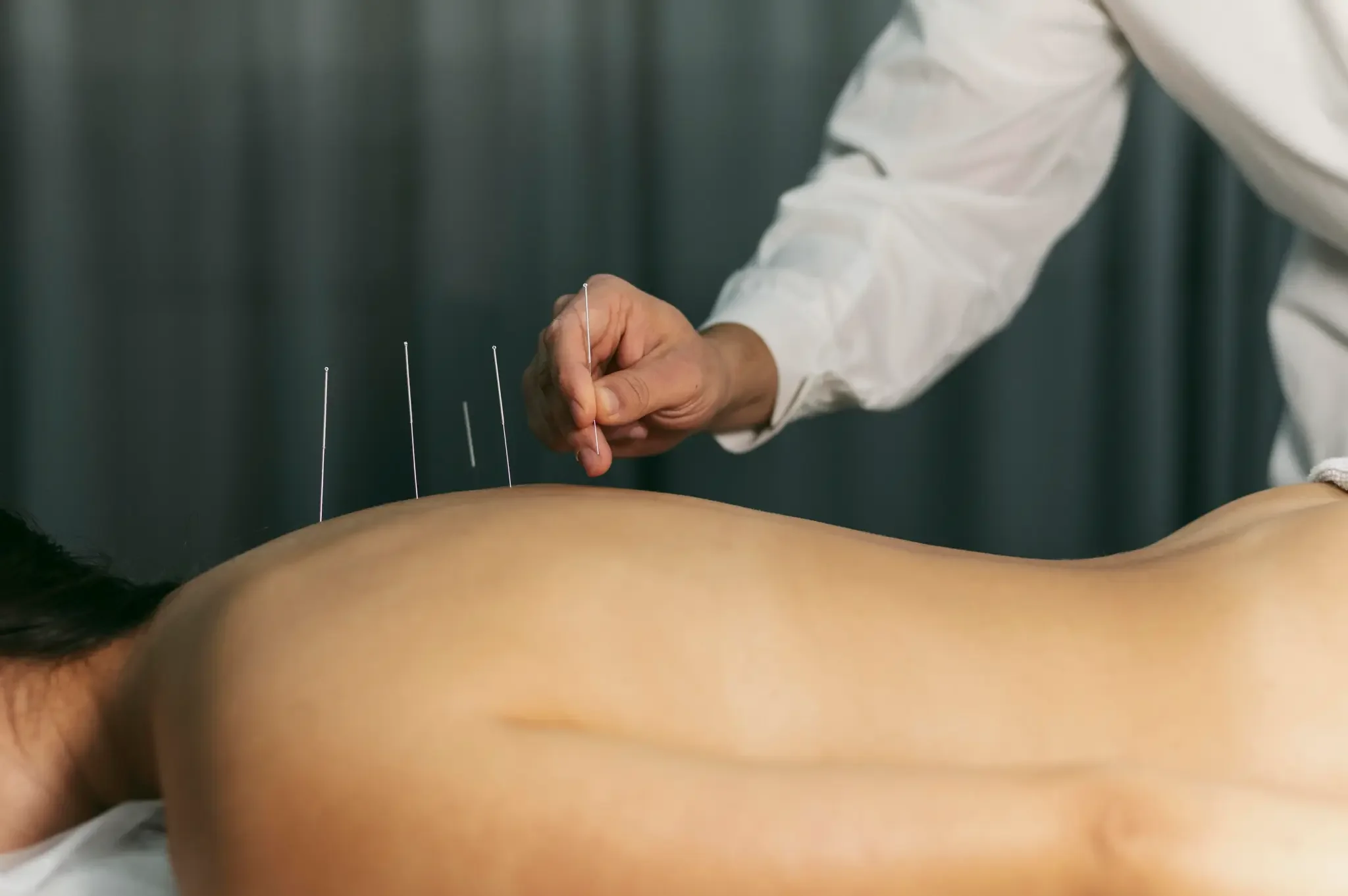 Person receiving acupuncture treatment with several acupuncture needles inserted into their back while a practitioner adjusts one needle.