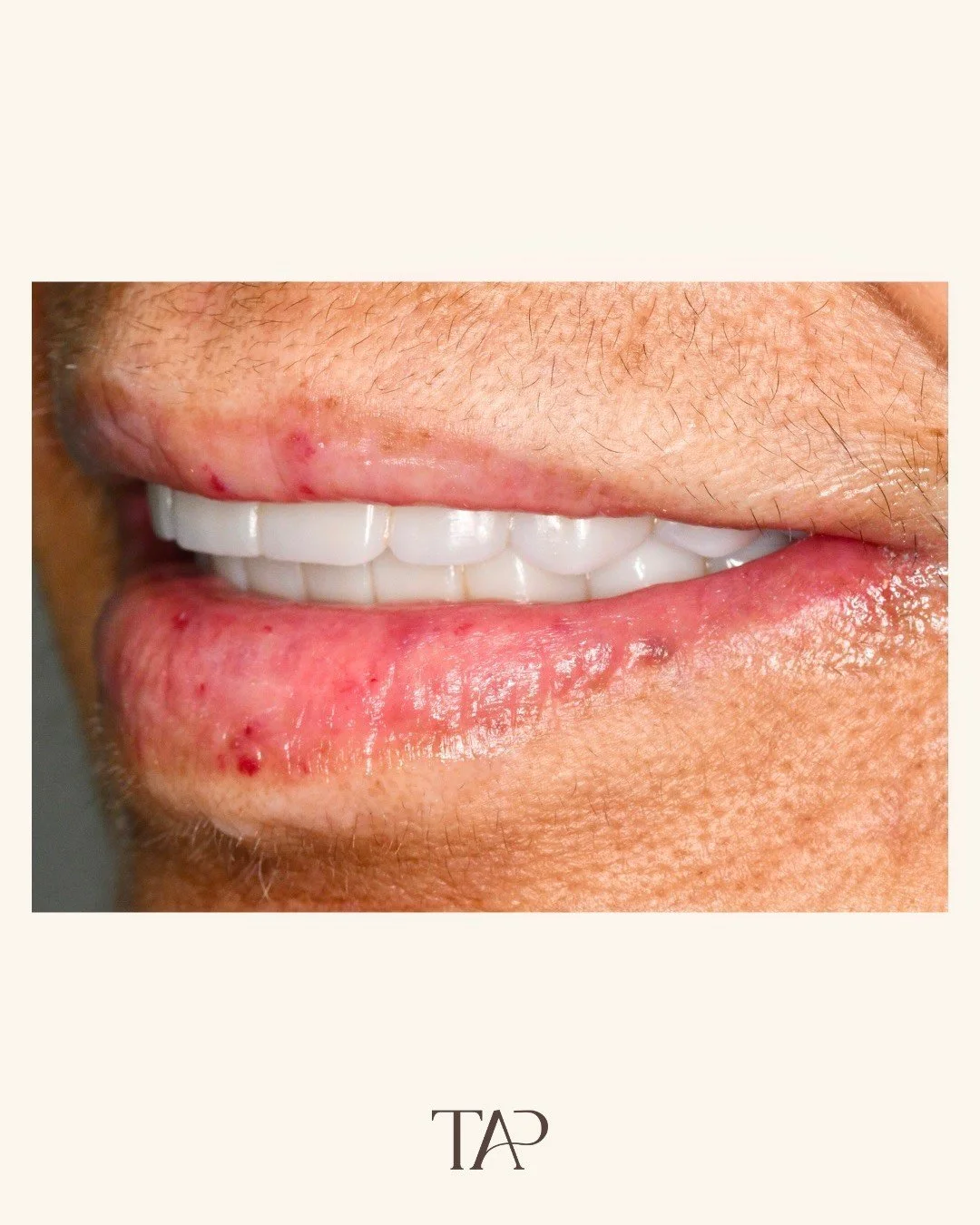 This is what happens when you stop managing and start restoring 🤍

When this patient came to us, she was dealing with missing teeth, worn and discoloured dentition, an uneven smile.
We see this more than you'd think.

As prosthodontists, we don't ju