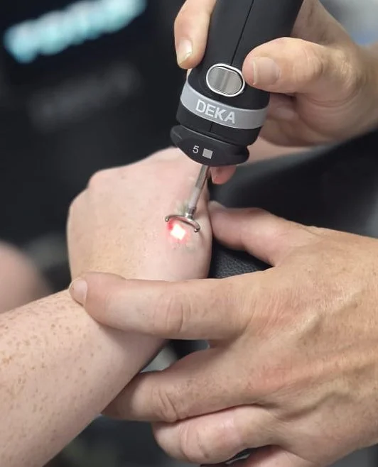 Close up image of Deka Toro Laser in use removing a tattoo on a hand at Limitless Laser Clinic