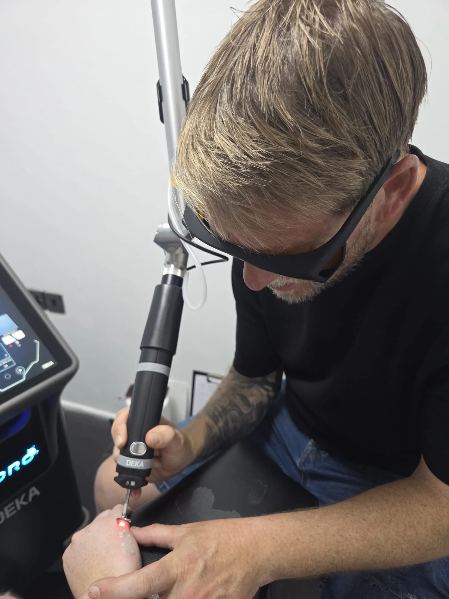 Deka Toro Laser being used by Limitless Laser Clinic to remove a tattoo on a hand