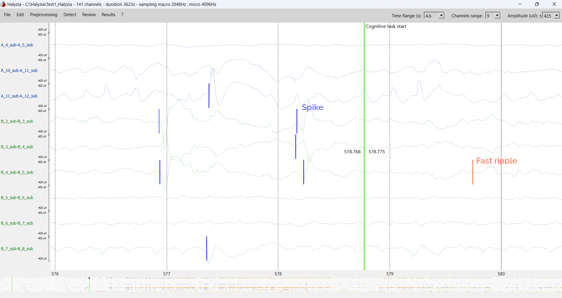 Graph displaying brain wave activity with annotations indicating a spike and fast ripple, with labels 'Spike' and 'Fast ripple', along with a green vertical line marking a cognitive task start.