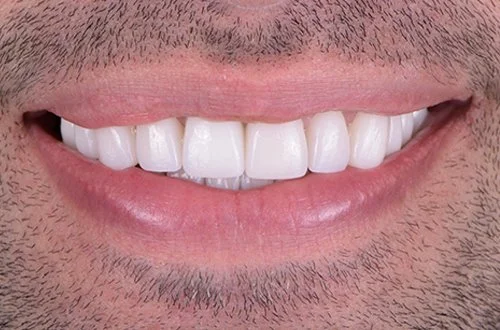 Close-up of a person's smiling mouth showing white teeth and pink lips.