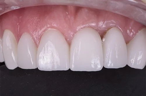 Close-up of a person's upper front teeth with dental veneers or crowns.
