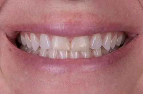 Close-up of a person's smiling mouth with slightly crooked, uneven teeth.
