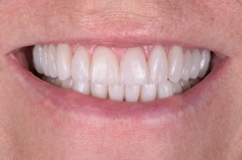 Close-up of a person's smiling mouth showing white, straight teeth.
