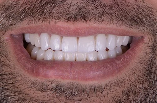 Close-up of a person's smiling mouth with visible teeth and facial hair.