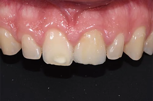 Close-up of upper front teeth with visible signs of discoloration and dental wear, against a dark background.