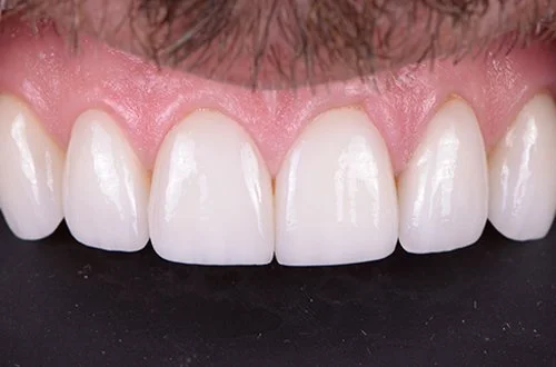 Close-up of a person's upper front teeth and gums.