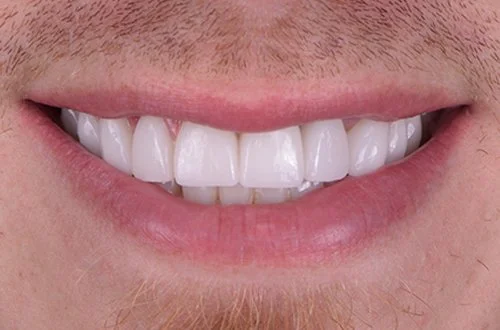 Close-up of a person's smiling mouth showing white teeth and pink lips.