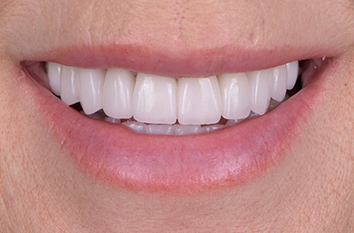 Close-up of a person’s smile showing straight, white teeth.