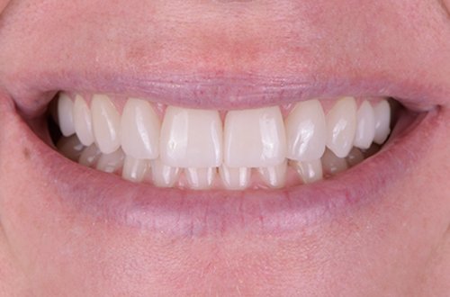 Close-up of a person's smile showing their teeth and lips.