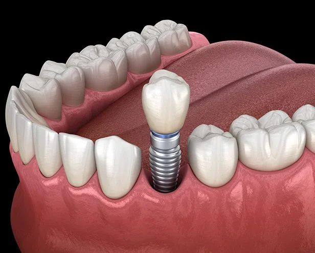 Close-up illustration of a dental implant replacing a missing tooth in the lower jaw, showing a prosthetic tooth attached to an implant screw in the gum.