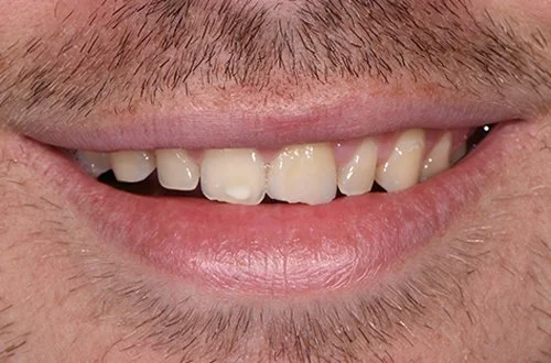 Close-up of a person's smiling mouth with visible teeth and facial hair.