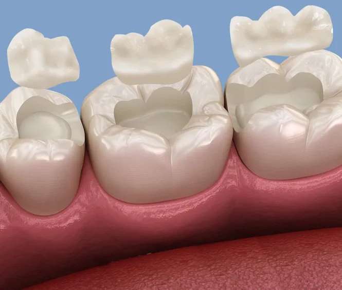 Close-up view of molar teeth with dental sealants applied to the chewing surfaces.