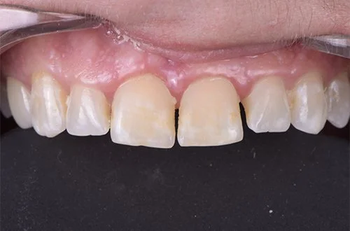 Close-up of upper front teeth showing chipped and uneven teeth with visible gaps.