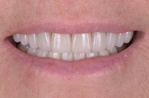 Close-up of a person's smiling mouth showing upper and lower teeth with dental veneers or crowns.