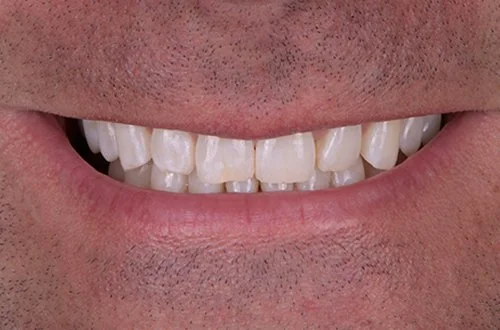 Close-up of a smiling person's teeth and lips.