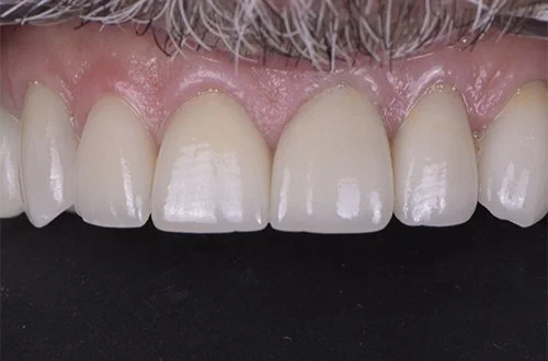 Close-up of upper front teeth and gums, showing dental veneers or crowns on the front teeth.