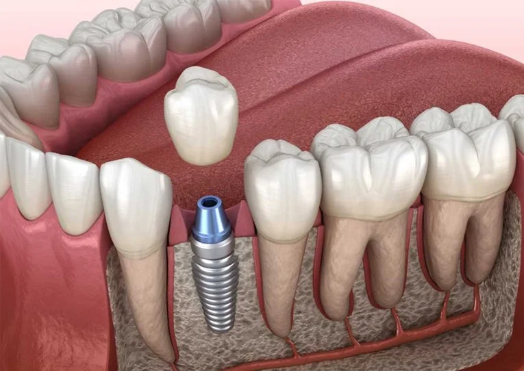 A dental diagram showing a dental implant procedure with a titanium implant post, a tooth crown above it, and natural teeth surrounding it.