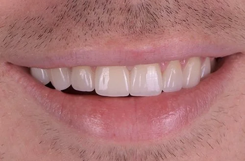 Close-up of a person's smile showing their upper front teeth.