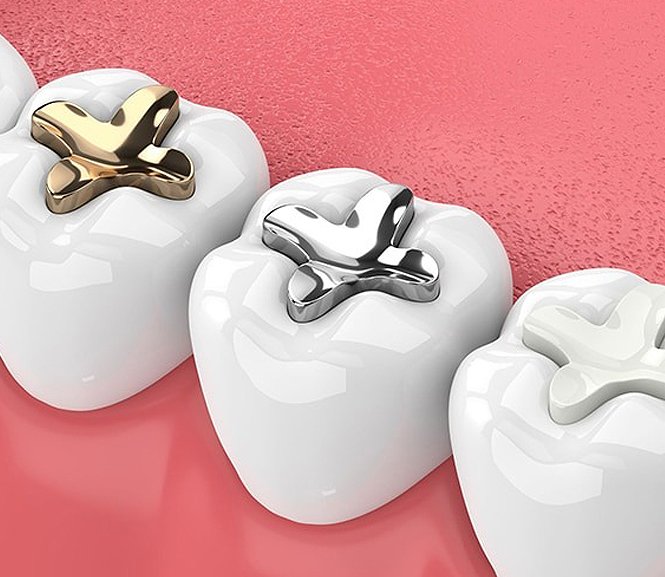 Close-up view of three molar teeth with metallic and gold dental crowns on a pink background.
