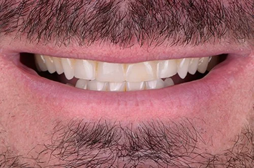 Close-up of a smiling person's mouth showing upper and lower teeth, beard, and mustache.