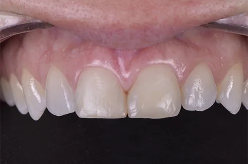 Close-up of a person's upper front teeth with visible gaps and uneven edges, showing some dental discoloration.