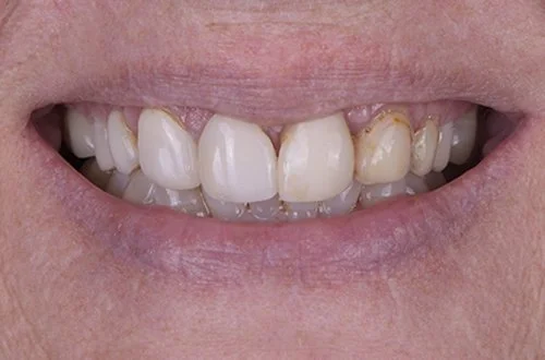 Close-up of a person's smile showing discolored and uneven teeth.
