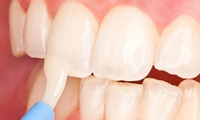 Close-up of a person applying whitening gel to their front teeth with a blue applicator.